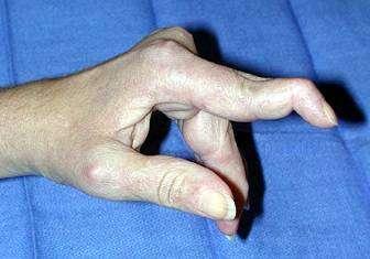 The Extensor System Internal Derangement Closed Injury: Mallet Finger Forced flexion Injury at Zone I- DIP joint Detachment of