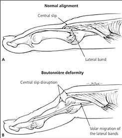 The Extensor System Internal Derangement Closed Injury: Boutonnier Deformity PIP Flexion injury and injury to the Central Band at or near its point of attatchement at the base of the middle phalanx