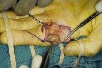 Finger: Soft Tissue Masses & Tumors Giant Cell Tumor Intraoperative excision of the giant