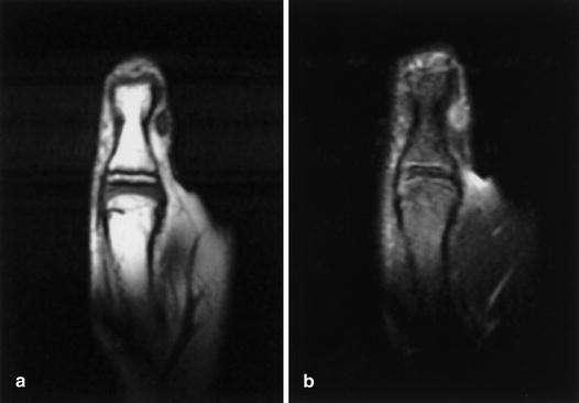 Finger: Soft Tissue Masses & Tumors Neurofibroma Tumor arising from Nerve sheath Benign Well-circumscribed Age 20-30