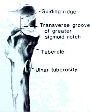 Ulna * * Sigmoid or Trochlear Notch Olecranon