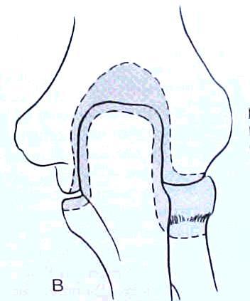 proximal distal