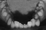 4 Many clinicians hypothesize that retroclination of the maxillary central incisors in class II Div 2 malocclusion is caused by increased resting lip pressure.