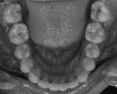 It could be argued that people with class II division 2 malocclusion look smart and it could be one reason for their not seeking treatment.