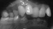 maxillary incisors and consequently reduce the post orthodontic relapse. Limitations imposed by the soft tissues enveloping the dentition were thought to be inviolable.