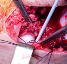 suture technique Capsular