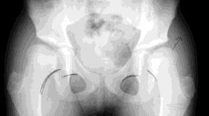 Assess Congruency in ABD/IR 8y/o ABD/IR If the hip(s) do congruently reduce, then we can redirect hyaline cartilage over hyaline