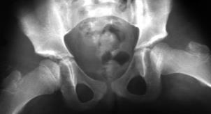 8y/o ABD/IR YES PFO Salter Pemberton Dega Triple Ganz NO Shelf Chiari +/- s of Pelvic Osteotomies Salter - - - - Limited