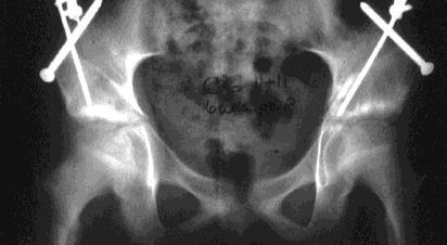11y/o bilat hip pain 8
