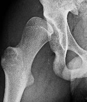 Developmental Hip Dysplasia in the Skeletally