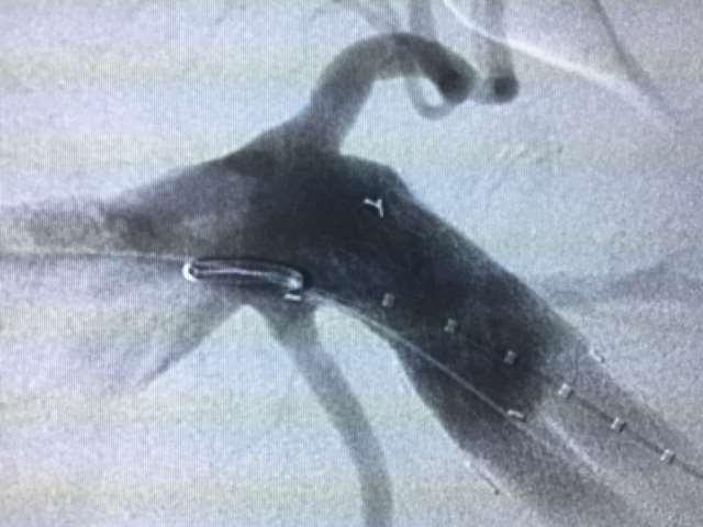 Impact of such devices Control and conformability are built into the EVAR and TEVAR endovascular systems What would this achieve?