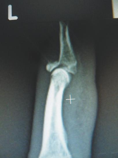 Note the hyperextension of the proximal interphalangeal joint (PIP) attachment on the middle phalanx causing proximal interphalangeal joint (PIP)