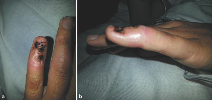 2 Closed Injuries: Bone, Ligament, and Tendon 15 Fig. 2.6 a, b Crush avulsion injury to the tip of the fifth finger involving the terminal extensor.