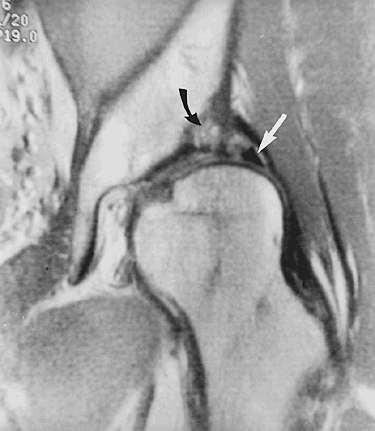 Dysplasia with labral