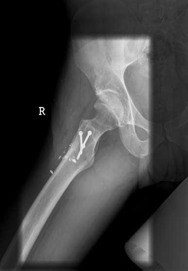 Inadequate Femoral Offset