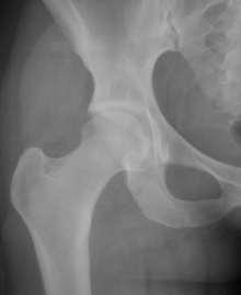 Hip arthroscopy Example 29 year old woman with