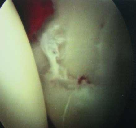 Hip Arthroscopy Example At surgery a torn labrum was