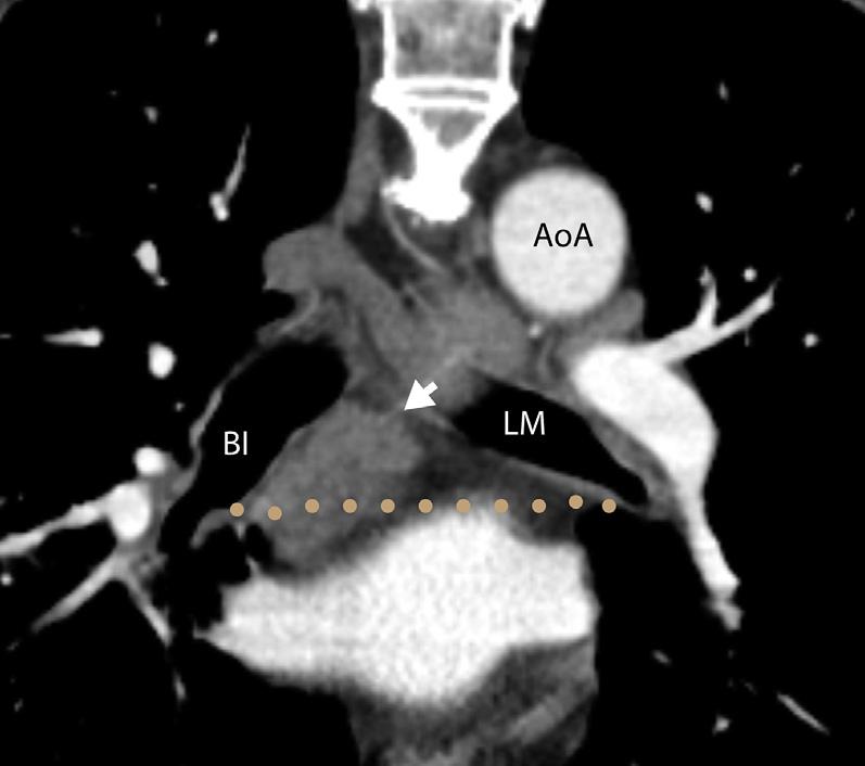 362 Jawad et al Fig. 12. Stations 7, 11, and 13. Axial CT of the chest shows multiple enlarged lymph nodes representing stations 7 (olive green arrow), 11 (green arrows), and 13 (purple arrow).