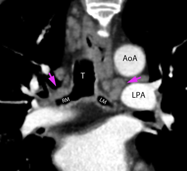 Axial CT of the chest at the level of pulmonary ligament demonstrates 2 enlarged, calcified station 9 lymph nodes (arrowheads).