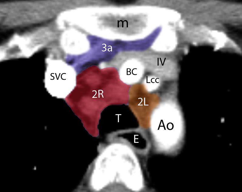 Thoracic Lymph Node Classification System 359 Fig. 3. Station 1. (A) Axial CT of the chest shows location of 1R and 1L lymph node stations (highlighted in pink).