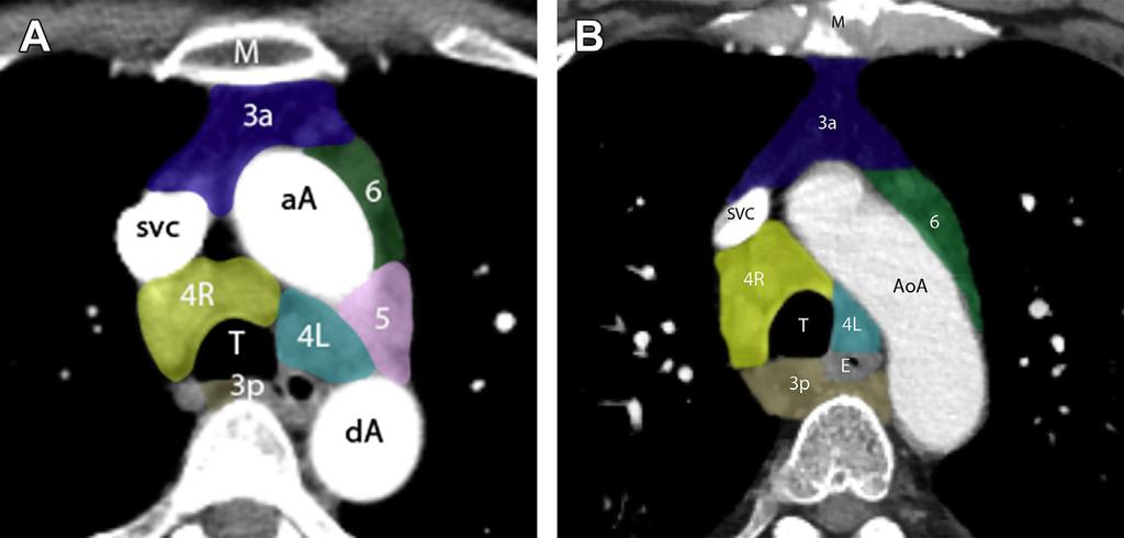 360 Jawad et al Fig. 6. Coronal CT scan of chest shows the caudal border (blue dotted line) of the left innominate vein which forms the inferior border of station 2R.