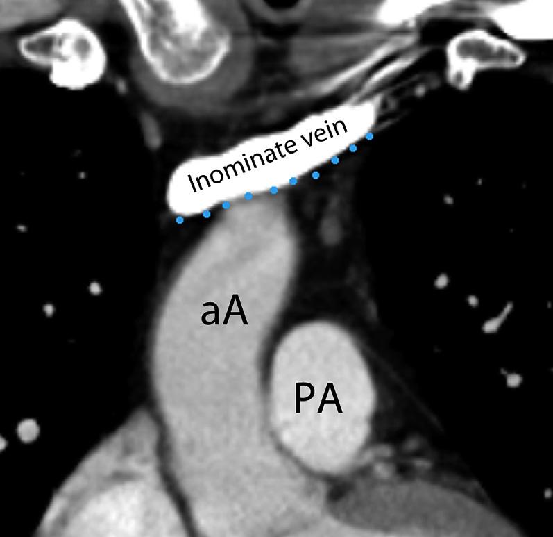 left main bronchus at the upper margin of the origin of the upper lobe bronchus. It is now at the upper rim of the left main pulmonary artery (Fig. 9).