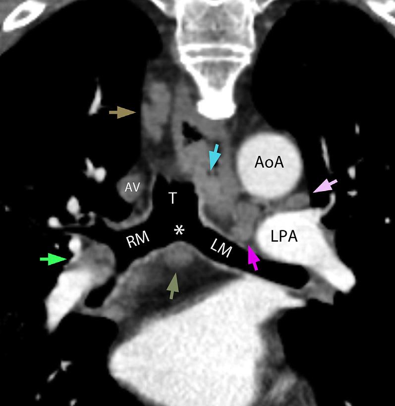 Thoracic Lymph Node Classification System 361 Fig. 8. Stations 4R and 5. Coronal chest CT demonstrates an enlarged station 4R lymph node (yellow arrow) adjacent to the azygos vein (white arrow).