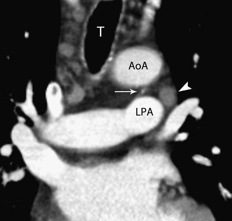 AoA, aortic arch; LPA, left main pulmonary artery; RPA, right main pulmonary artery. station 7 nodes superiorly to the diaphragm inferiorly.