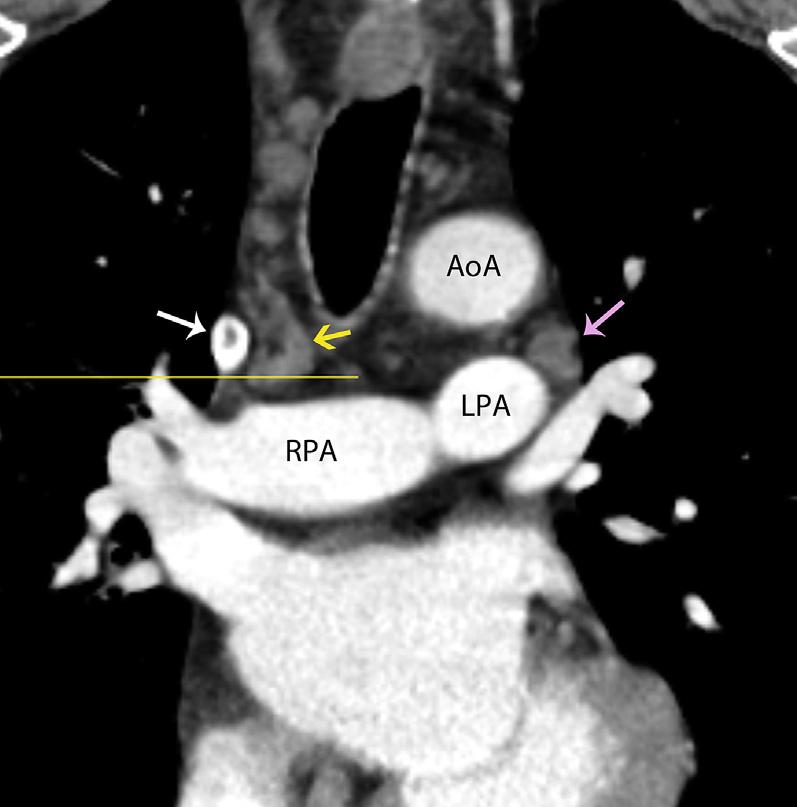 Coronal CT of the chest shows multiple enlarged lymph nodes including stations 3p (brown arrow), 4L (blue arrow), 5 (pale pink arrow), 7 (olive green arrow), 10 (magenta arrow), and 11 (bright green
