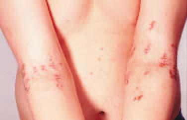 Histiocytosis X usually involves the scalp and flexures with purpura. Allergic contact dermatitis may present in children and adults.