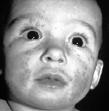 Other Possible Features of AD Dennie-Morgan infra-orbital folds Orbital Darkening Facial erythema or pallor 3 Phases of Atopic Dermatitis Infantile Phase exudative, erythematous papules and vesicles