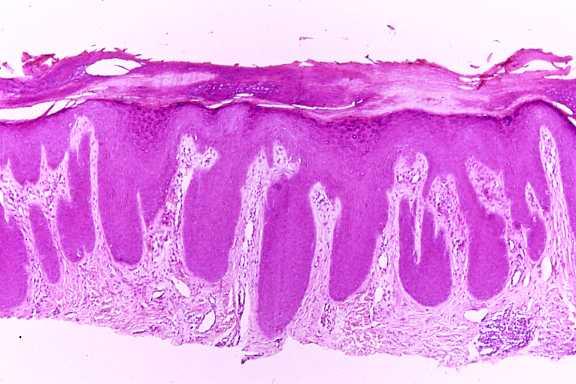 (lichen simplex chronicus) depending on the chronicity of the rash.