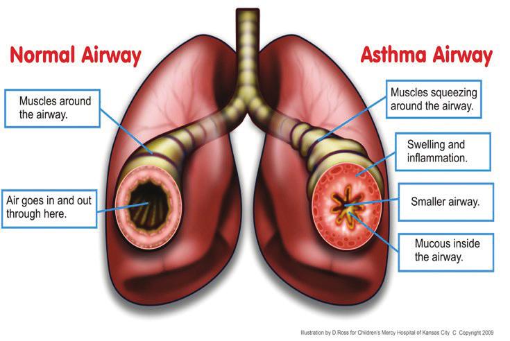 WHAT CAUSES ASTHMA SYMPTOMS? Asthma airways are sensitive or easily bothered. 1. 2. 3. 4. What happens to the airway? 1. Muscle squeeze 2.