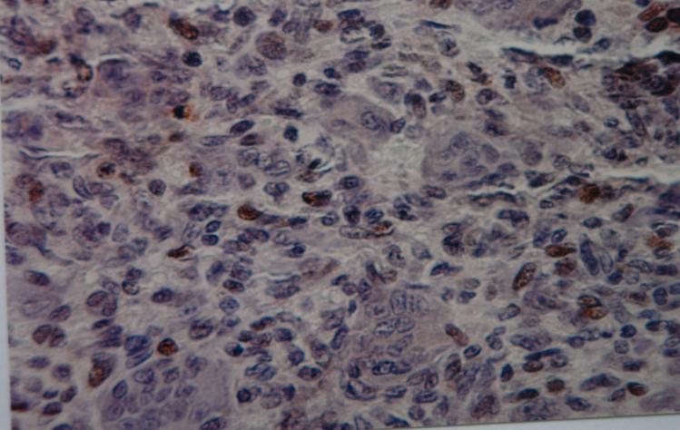Figure 1: Positive IHC staining of anti(pcna) antibody in