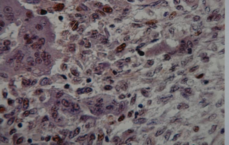 Figure 2: Positive IHC staining of anti (PCNA) antibody in