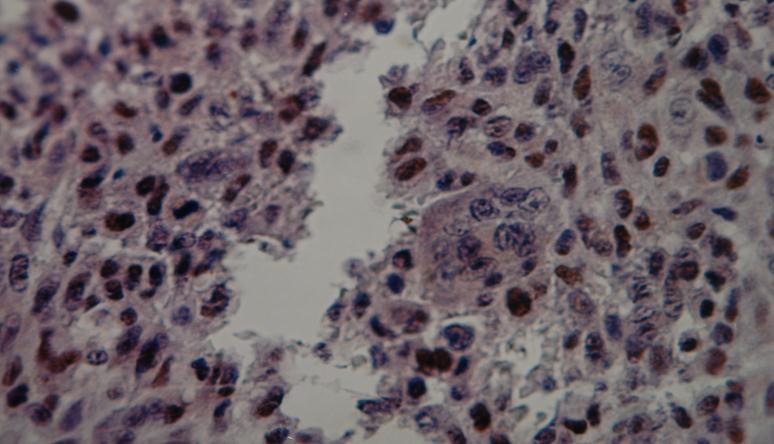 Figure 3: Positive IHC staining of anti (PCNA) antibody in