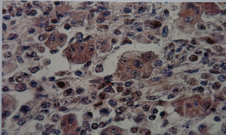 Figure 4 :IHC staining wiht anti(p53)antibody in stromal cells in