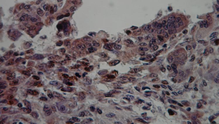 Figure 5: Positive IHC staining with anti (P53) antibody in stromal