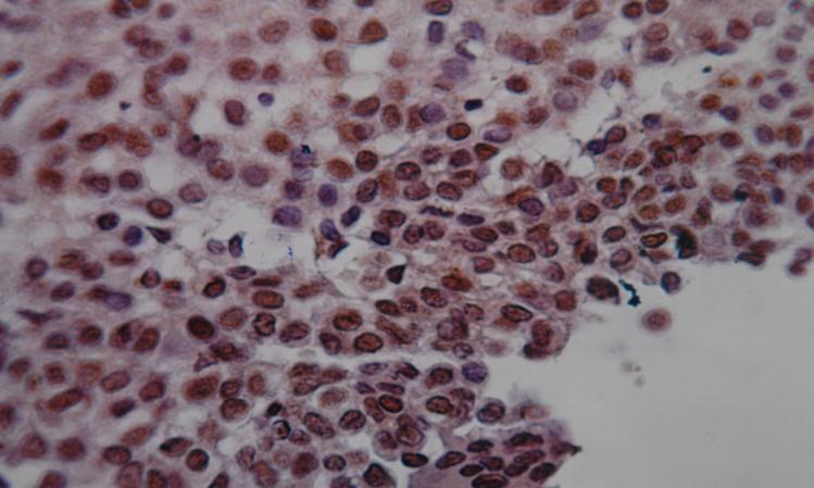 Figure 6: Positive IHC staining with anti (P53) antibody in stromal