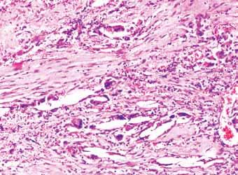 stain at 20 magnification) Fig. 7: Photomicrograph showing areas of ameloblastomaotus proliferation (H and E stain at 20 magnification) Fig.
