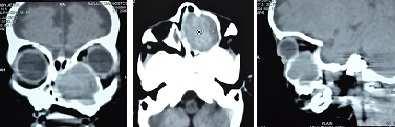 Figure 2a: CT Scans Revealing the extent of the lesion. An intra-oral maxillary vestibular incision was made extending from the midline to the first molar region bilaterally.