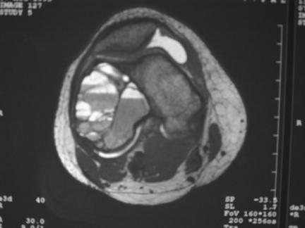 lower end femur with trabeculation in the wall of the lesion (fig. 2) x-ray chest did not revealed any metastatic deposit.