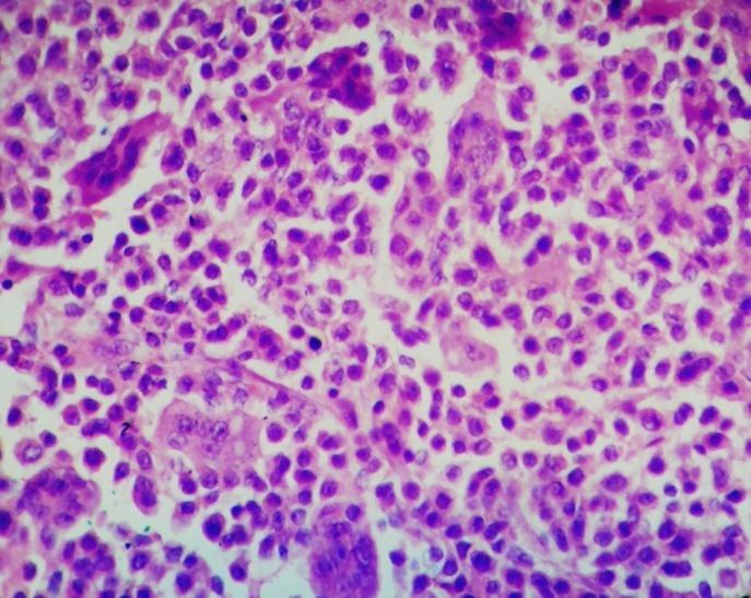 The fine needle aspiration cytology was consistent with diagnosis of giant cell tumour.