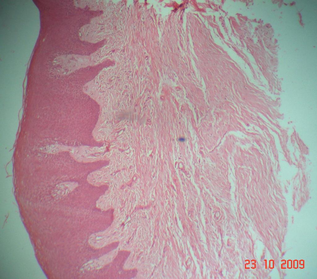 Fig.V: Histological section showing normal mucosa after 8 months postoperatively (H & E Stain, 1X). Fig.