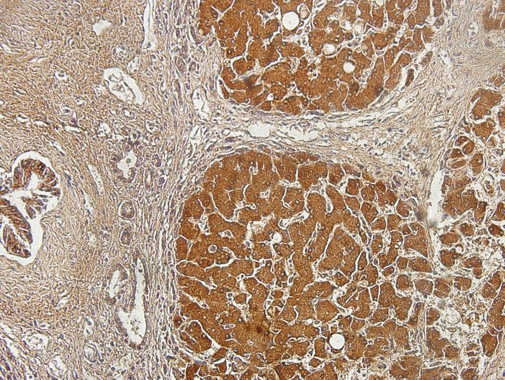 U tkivu jetre zahvaćene nodularnom cirozom vidljiva je izrazita BMP-9 pozitivna reakcija u regenerativnim čvorićima jetrenog parenhima te u epitelu žučnih kanalića (Slika 7). Slika 7.