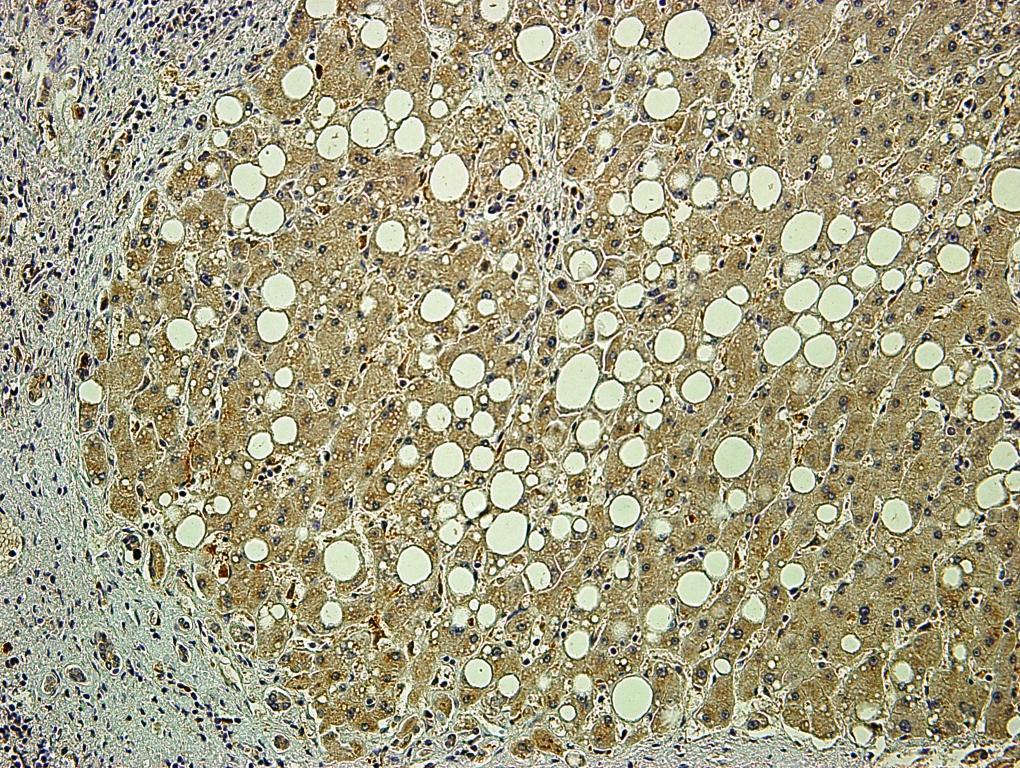 U uznapredovaloj cirozi TGF-β1 je eksprimiran u hepatocitima unutar čvorića zdravog parenhima jetre. Vezivne pregrade sadržavaju pokoji žučni kanalić pozitivnih epitelnih stanica.