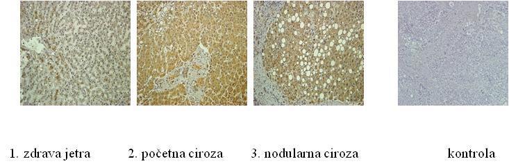 Relativna ekspresija TGFβ1 (PJ) * * nodularna ciroza početna ciroza zdrava jetra Slika 12.