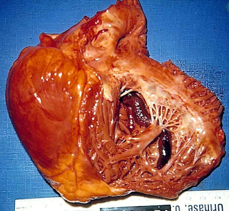 R Ventricle
