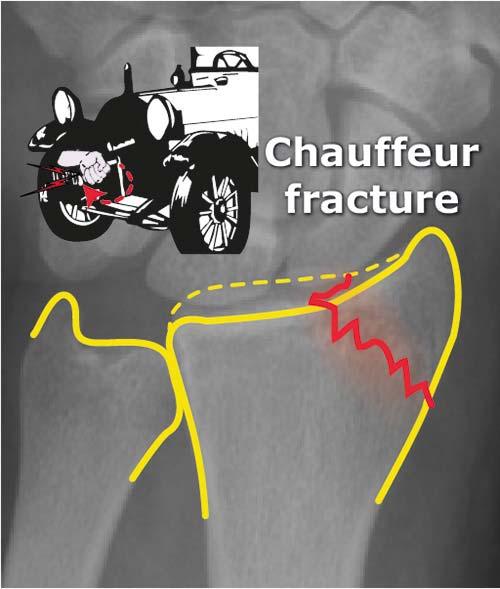 Chauffeur's fracture Intra articular fractures of the radial styloid process.