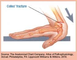 Colles fracture Complete fracture of the distal radius with